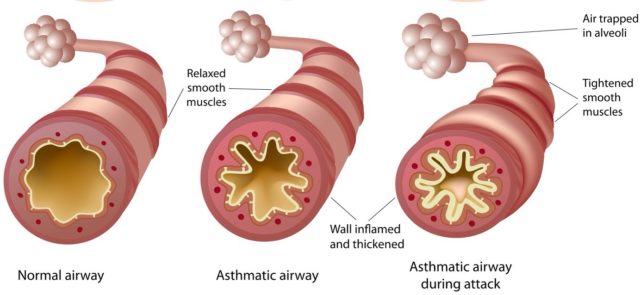 Asthma-diagram.jpg