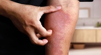 WHAT IS ECZEMA?