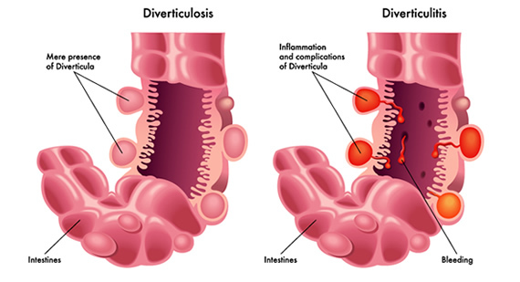 ABOUT DIVERTICULOSIS AND DIVERTICULITIS