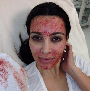 Kim Kardashian After Vampire Facial (R) Procedure